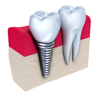Dental Implant 3D Visual