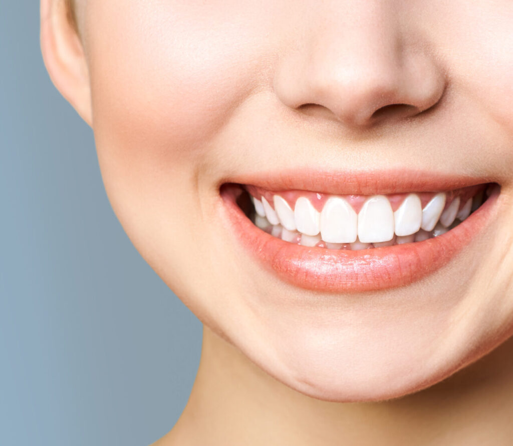 Professional Teeth Whitening