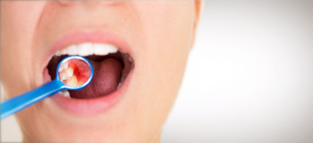 Gum disease is an inflammatory disease that affects the tissues that surround and help support your teeth. It's a major cause of tooth loss in adults, and can be painless or cause major tissue damage.
