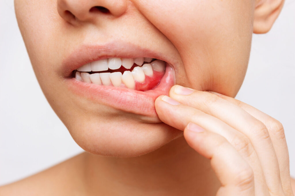 First Signs of Gum Disease