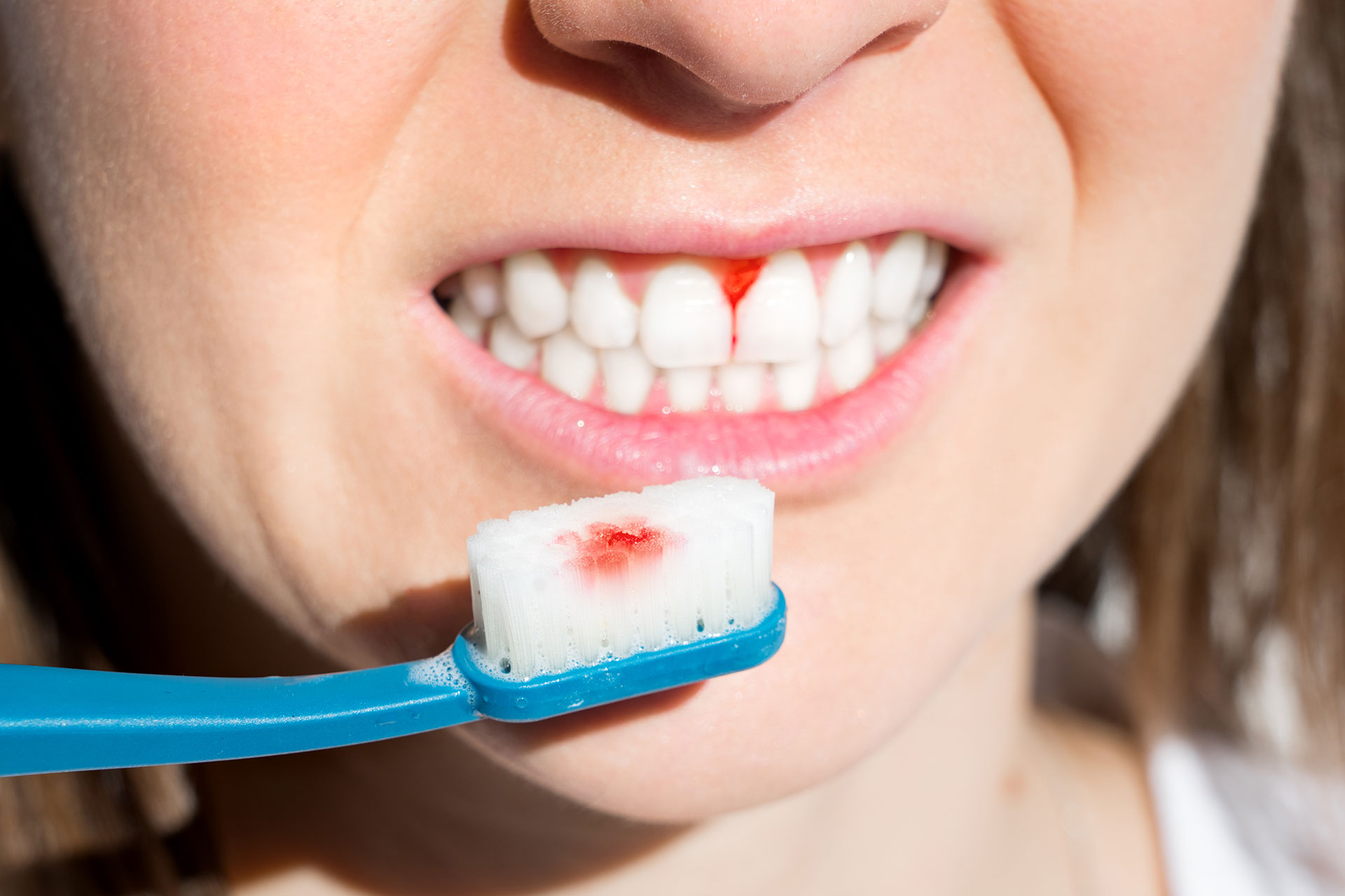 Are Bleeding Gums a Dental Emergency? Understanding, Identifying, and Managing