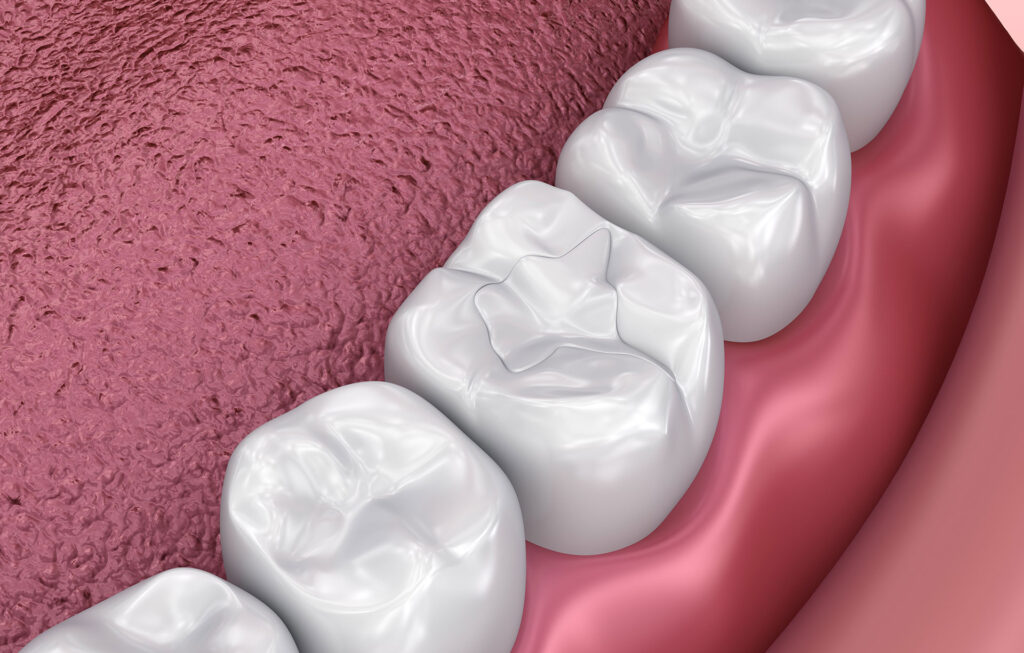 Cracked or Broken Teeth: Emergency Repairs and Long-Term Solutions