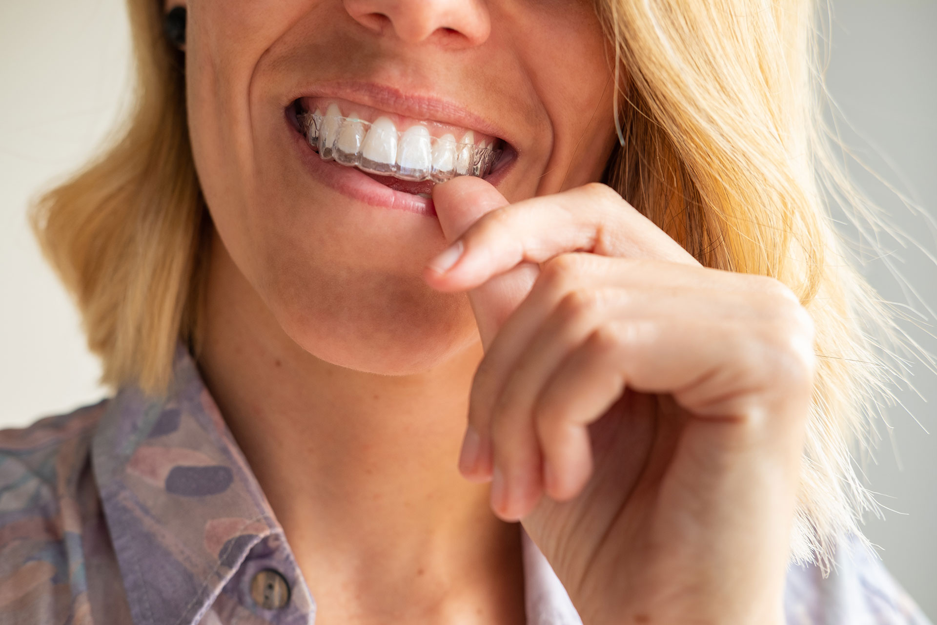 Straighten Your Smile with Invisalign: A Clear Alternative to Braces