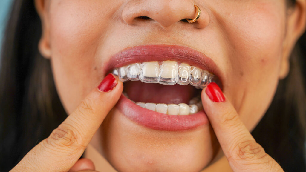The Impact of Invisalign on Your Confidence